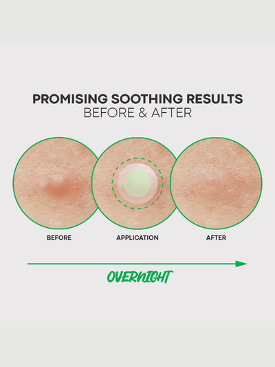 Applying Nolahour Spot Eraser Green Step 1 to early-stage acne to shrink and flatten blemishes before they worsen