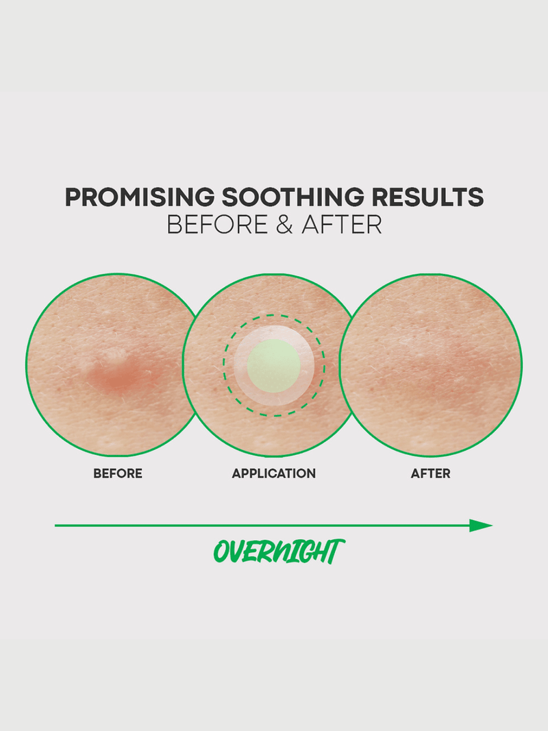 Applying Nolahour Spot Eraser Green Step 1 to early-stage acne to shrink and flatten blemishes before they worsen