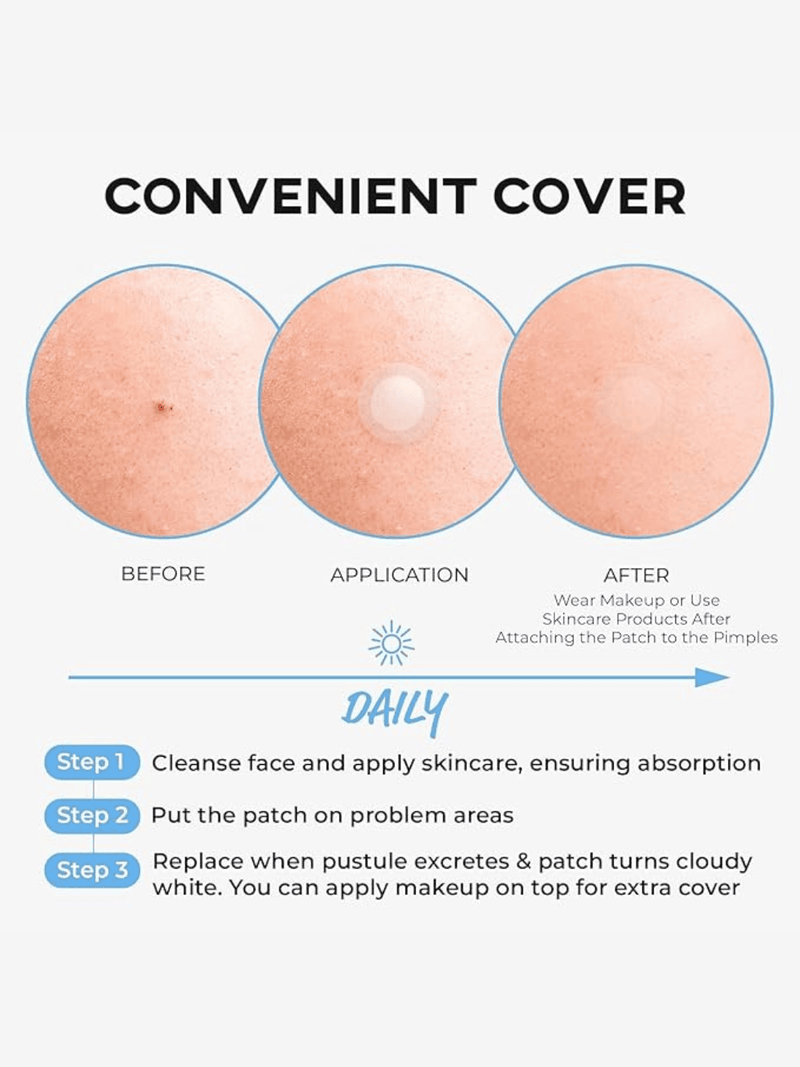 Applying Nolahour Spot Eraser Blue - Step 2 patch to popped acne for effective pus absorption and fast healing.